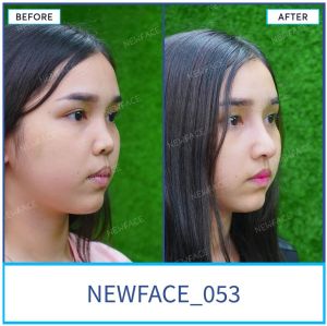 Hình ảnh nâng mũi trước sau Bs Trần Phương - Ca 53