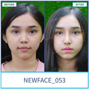 Hình ảnh nâng mũi trước sau Bs Trần Phương - Ca 53