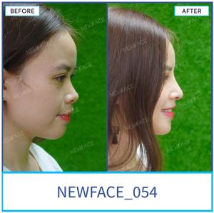 Hình ảnh nâng mũi trước sau Bs Trần Phương - Ca 54