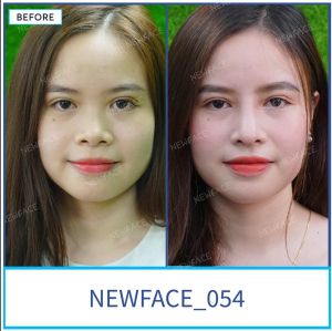 Hình ảnh nâng mũi trước sau Bs Trần Phương - Ca 54