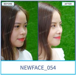 Hình ảnh nâng mũi trước sau Bs Trần Phương - Ca 54