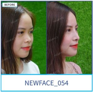 Hình ảnh nâng mũi trước sau Bs Trần Phương - Ca 54