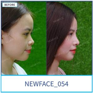 Hình ảnh nâng mũi trước sau Bs Trần Phương - Ca 54