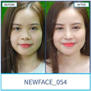 Hình ảnh nâng mũi trước sau Bs Trần Phương - Ca 54