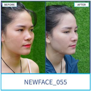 Hình ảnh nâng mũi trước sau Bs Trần Phương - Ca 55