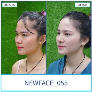 Hình ảnh nâng mũi trước sau Bs Trần Phương - Ca 55