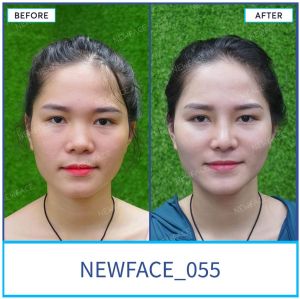 Hình ảnh nâng mũi trước sau Bs Trần Phương - Ca 55