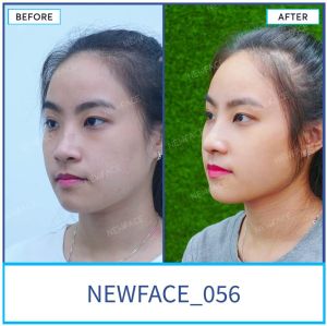 Hình ảnh nâng mũi trước sau Bs Trần Phương - Ca 56