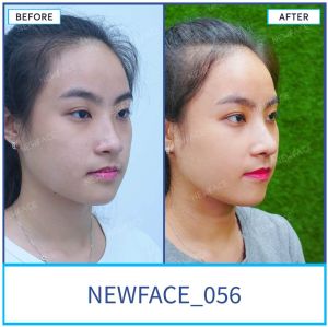 Hình ảnh nâng mũi trước sau Bs Trần Phương - Ca 56