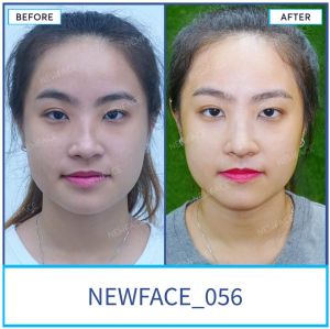 Hình ảnh nâng mũi trước sau Bs Trần Phương - Ca 56