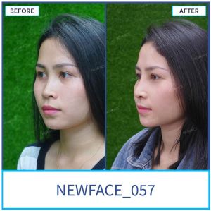 Hình ảnh nâng mũi trước sau Bs Trần Phương - Ca 57