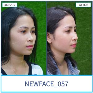 Hình ảnh nâng mũi trước sau Bs Trần Phương - Ca 57