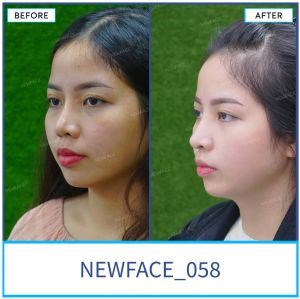 Hình ảnh nâng mũi trước sau Bs Trần Phương - Ca 58