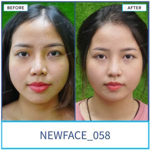 Hình ảnh nâng mũi trước sau Bs Trần Phương - Ca 58