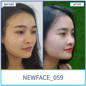 Hình ảnh nâng mũi trước sau Bs Trần Phương - Ca 59