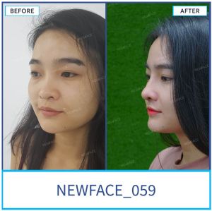 Hình ảnh nâng mũi trước sau Bs Trần Phương - Ca 59