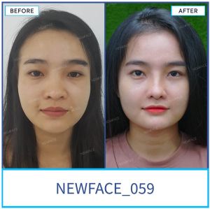 Hình ảnh nâng mũi trước sau Bs Trần Phương - Ca 59