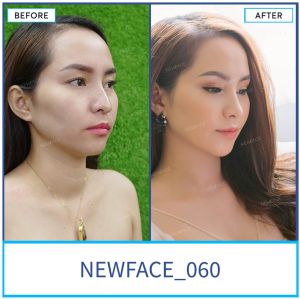 Hình ảnh nâng mũi trước sau Bs Trần Phương - Ca 60