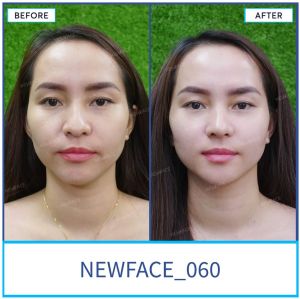 Hình ảnh nâng mũi trước sau Bs Trần Phương - Ca 60