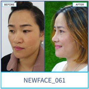 Hình ảnh nâng mũi trước sau Bs Trần Phương - Ca 61