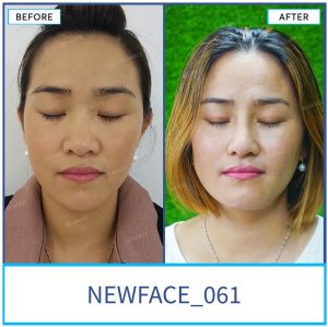 Hình ảnh nâng mũi trước sau Bs Trần Phương - Ca 61