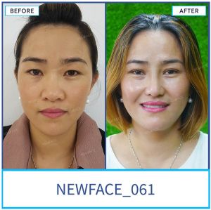 Hình ảnh nâng mũi trước sau Bs Trần Phương - Ca 61