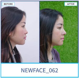 Hình ảnh nâng mũi trước sau Bs Trần Phương - Ca 62