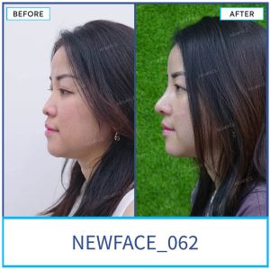 Hình ảnh nâng mũi trước sau Bs Trần Phương - Ca 62