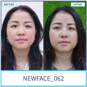 Hình ảnh nâng mũi trước sau Bs Trần Phương - Ca 62