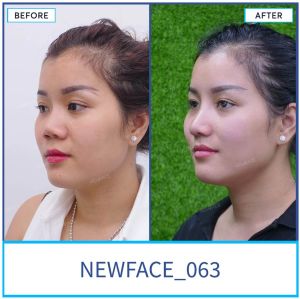 Hình ảnh nâng mũi trước sau Bs Trần Phương - Ca 63