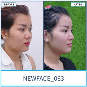 Hình ảnh nâng mũi trước sau Bs Trần Phương - Ca 63