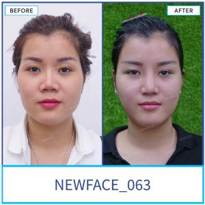 Hình ảnh nâng mũi trước sau Bs Trần Phương - Ca 63