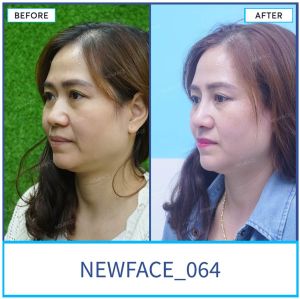 Hình ảnh nâng mũi trước sau Bs Trần Phương - Ca 64