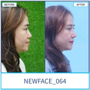 Hình ảnh nâng mũi trước sau Bs Trần Phương - Ca 64