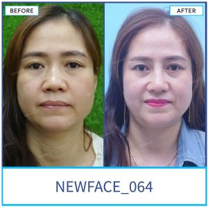 Hình ảnh nâng mũi trước sau Bs Trần Phương - Ca 64