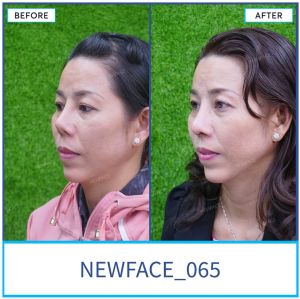 Hình ảnh nâng mũi trước sau Bs Trần Phương - Ca 65