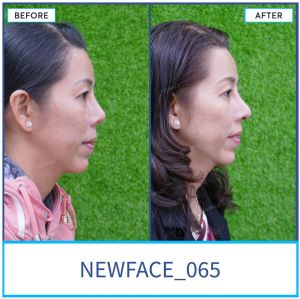 Hình ảnh nâng mũi trước sau Bs Trần Phương - Ca 65