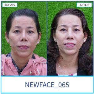 Hình ảnh nâng mũi trước sau Bs Trần Phương - Ca 65