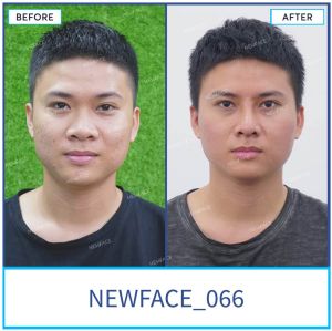Hình ảnh nâng mũi trước sau Bs Trần Phương - Ca 66