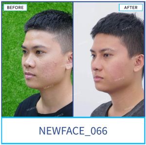 Hình ảnh nâng mũi trước sau Bs Trần Phương - Ca 66