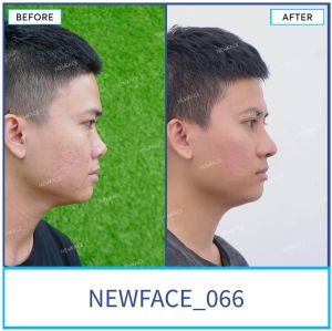 Hình ảnh nâng mũi trước sau Bs Trần Phương - Ca 66