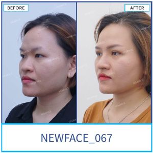 Hình ảnh nâng mũi trước sau Bs Trần Phương - Ca 67