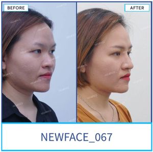 Hình ảnh nâng mũi trước sau Bs Trần Phương - Ca 67