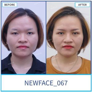 Hình ảnh nâng mũi trước sau Bs Trần Phương - Ca 67