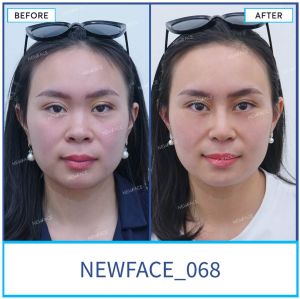 Hình ảnh nâng mũi trước sau Bs Trần Phương - Ca 68