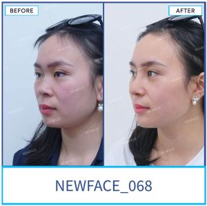 Hình ảnh nâng mũi trước sau Bs Trần Phương - Ca 68