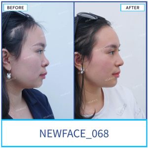Hình ảnh nâng mũi trước sau Bs Trần Phương - Ca 68