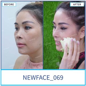 Hình ảnh nâng mũi trước sau Bs Trần Phương - Ca 69