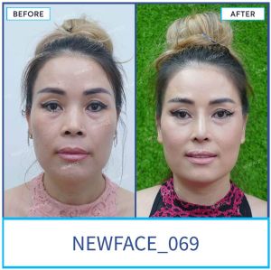 Hình ảnh nâng mũi trước sau Bs Trần Phương - Ca 69