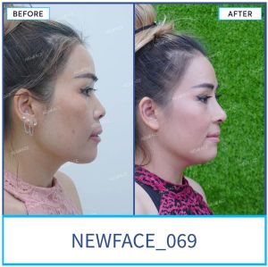 Hình ảnh nâng mũi trước sau Bs Trần Phương - Ca 69